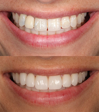 One Dental Implant and Six Porcelain Restorations