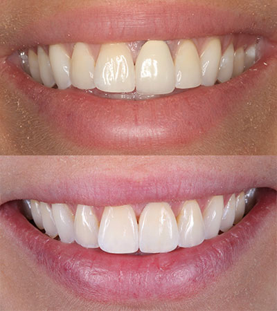 One Dental Implant and One Porcelain Restoration